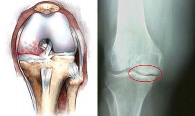 artrosi della radiografia del ginocchio