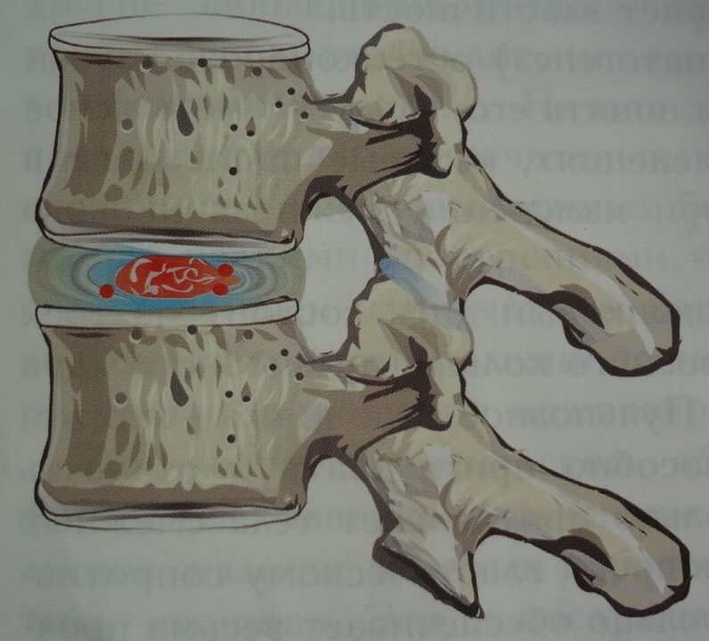 Danno al nucleo polposo del disco intervertebrale nella prima fase dell'osteocondrosi cervicale