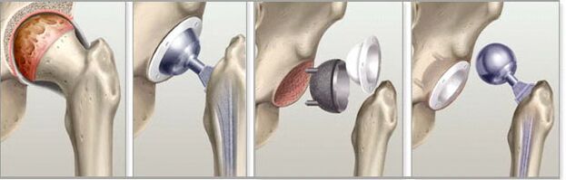 protesi d'anca per artrosi