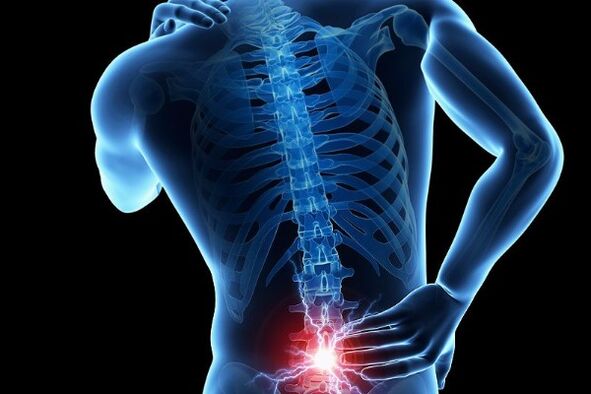 Il mal di schiena acuto è un sintomo dello spostamento dei dischi intervertebrali