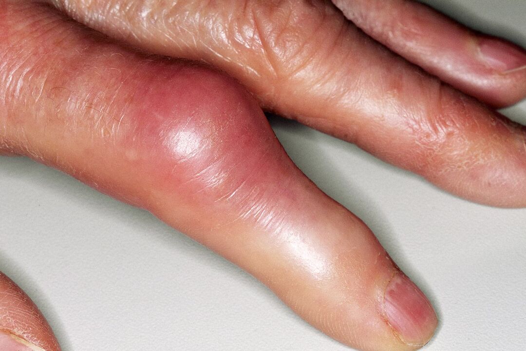 Gonfiore, deformazione dell'articolazione delle dita e dolore acuto dopo l'infortunio