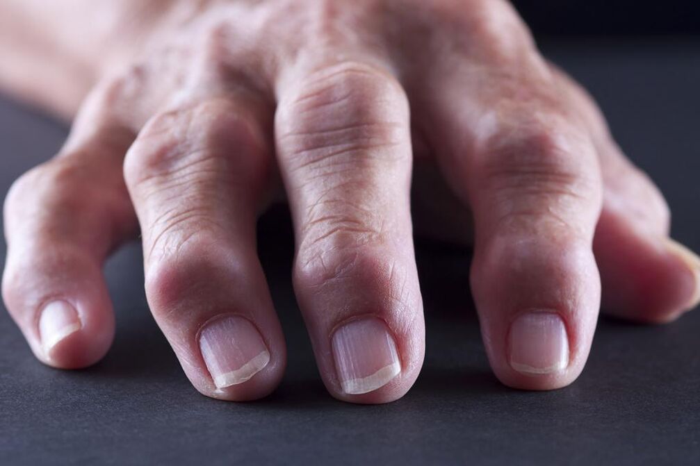 La borsite è caratterizzata da dolore, infiammazione e gonfiore delle articolazioni delle dita