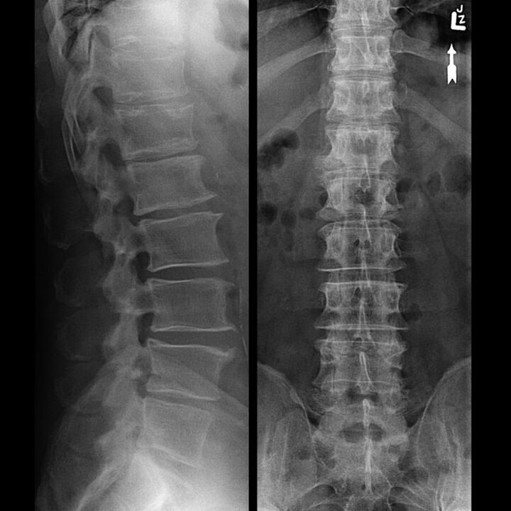 Sncing della colonna vertebrale con osteocondrosi