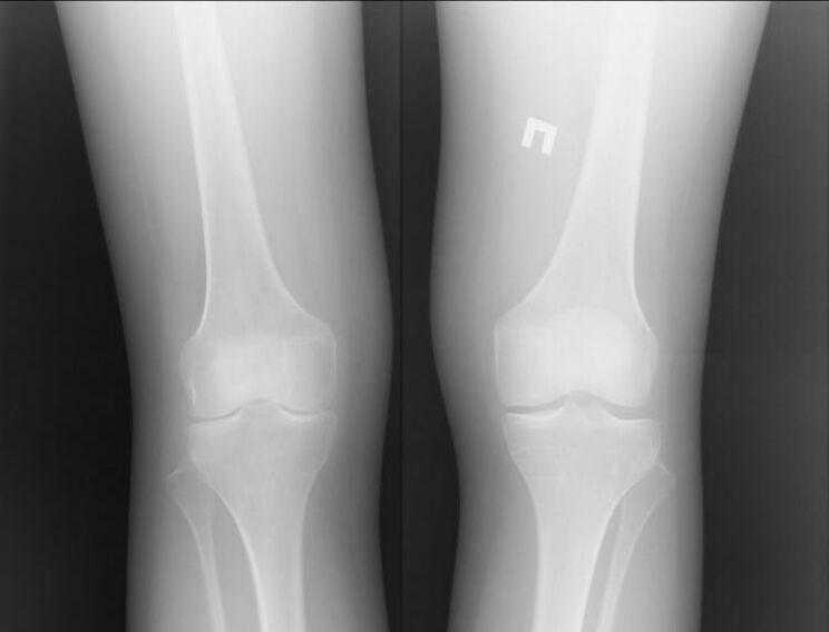Radiografia delle ginocchia colpite da artrosi