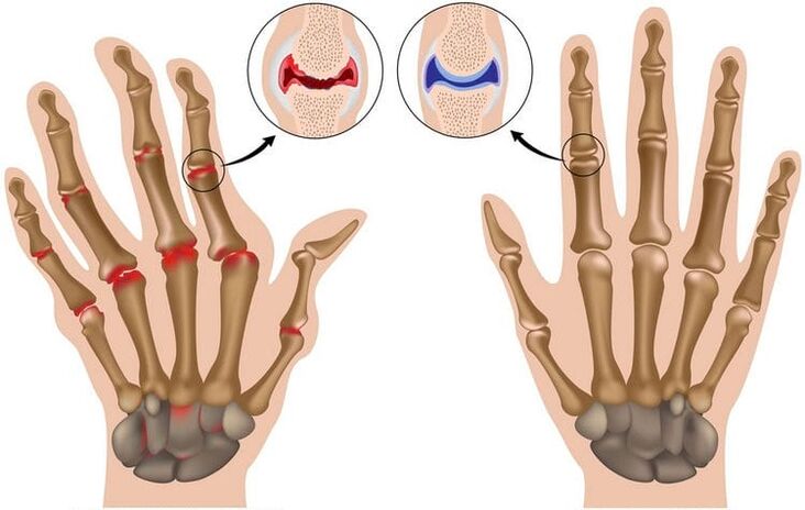 articolazioni sane delle mani e articolazioni danneggiate dall'artrosi