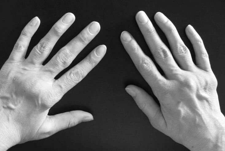 sintomi di artrite alle articolazioni delle mani