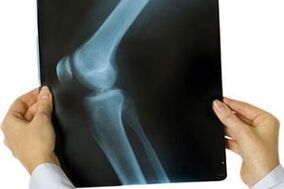 artrosi dell'articolazione del ginocchio alla radiografia