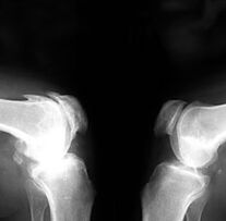 Artrosi alla radiografia