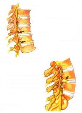 illustrazione dell'osteocondrosi spinale