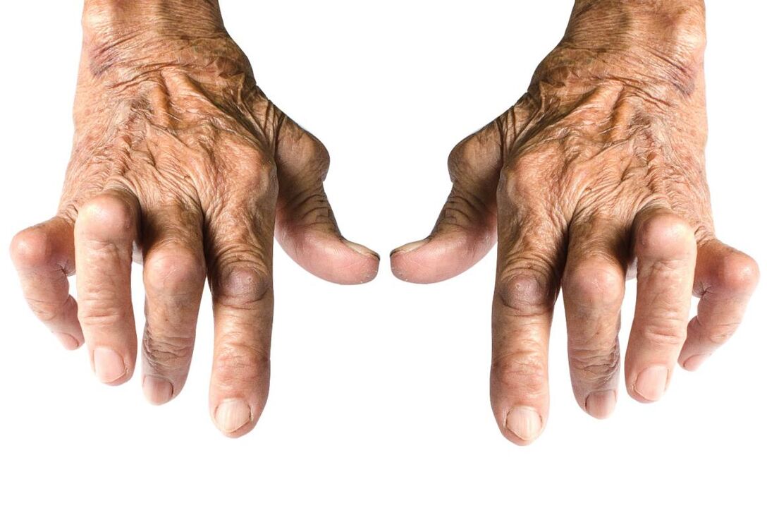 segni di artrite - deformità articolare